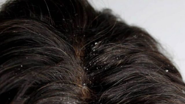 سيروم طبيعي للتخلص من تجعد الشعر والقشرة