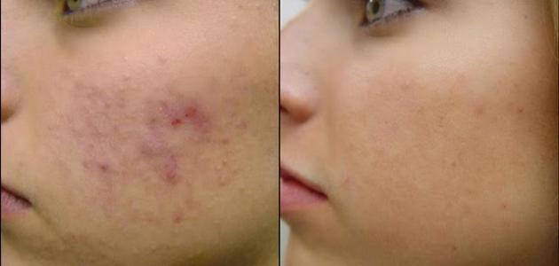 طرق إخفاء بقايا حب الشباب