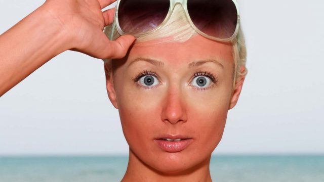 قناع العسل لعلاج حروق الشمس