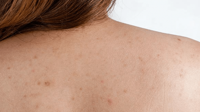 ماهي أسباب بثور الظهر