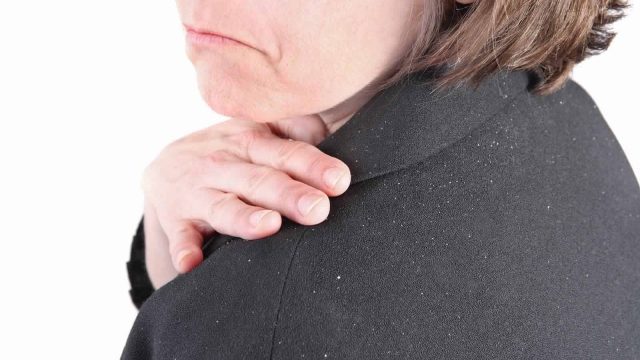 الفطريات هي سبب قشرة الرأس