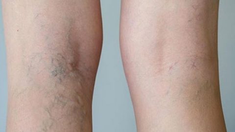 علاج زيت الزيتون والآذريون للتخلص من الدوالي