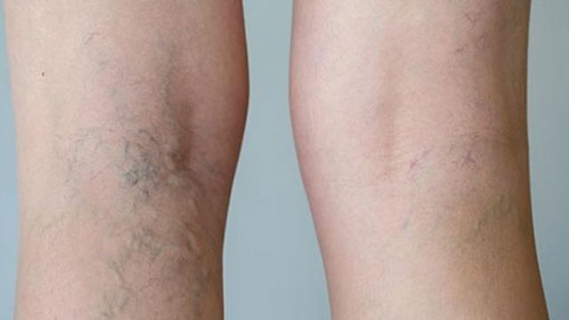 علاج زيت الزيتون والآذريون للتخلص من الدوالي