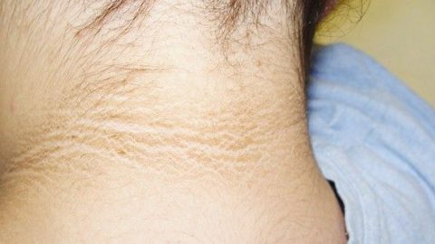 طرق طبيعية للتخلص من اسوداد الرقبة