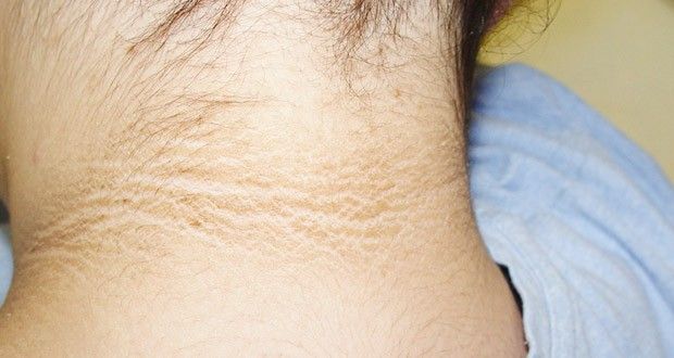 طرق طبيعية للتخلص من اسوداد الرقبة
