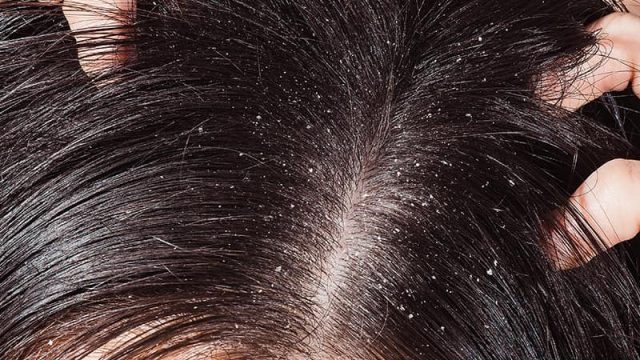 أهم الطرق لمعالجة قشرة الشعر