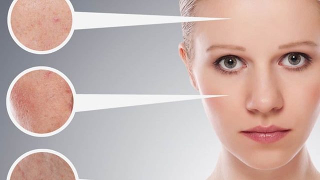 وصفات طبيعية لعلاج البشرة الدهنية