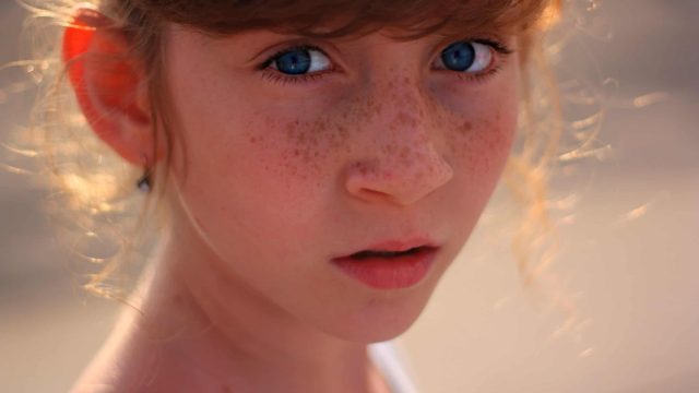 ماهي أسباب ظهور الكلف وطرق التخلص منه؟