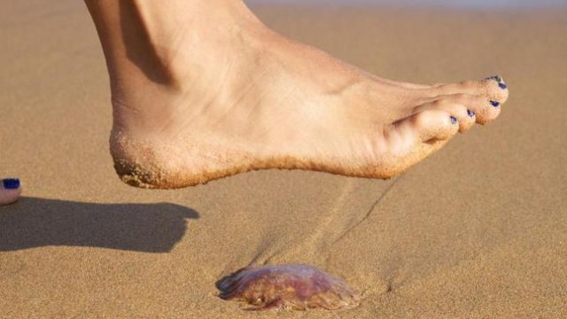 كيف تعالجين لسعات قناديل البحر؟