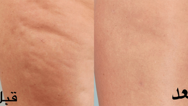 تخلصي من السيلوليت بهذه الوصفات البسيطة والفعالة