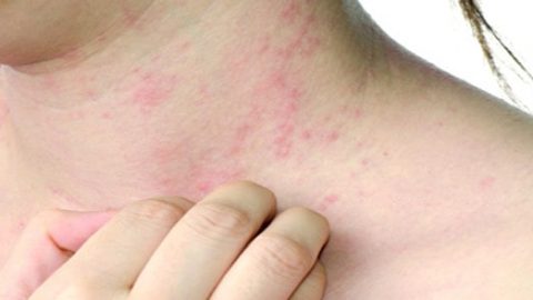 جربي هذه إحدى هذه الوصفات للتخلص من الحساسية