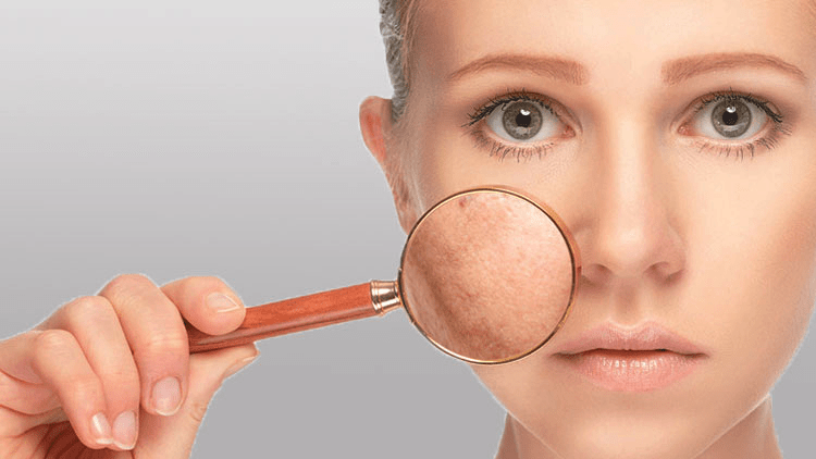 pores-dilates-visage