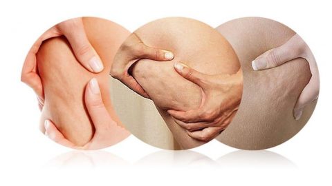 هذه المشروبات الطبيعية ستخلصك من مشكلة السيلوليت