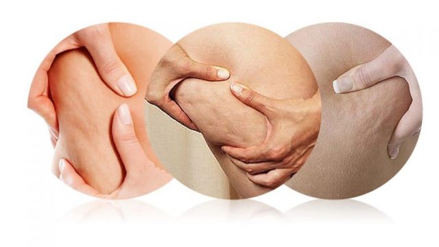 هذه المشروبات الطبيعية ستخلصك من مشكلة السيلوليت