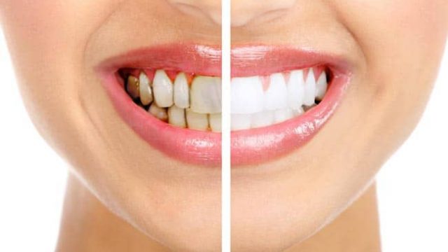وصفات طبيعية تخلصك من اصفرار الأسنان والتهابات اللثة