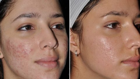 تخلصي من ندبات حب الشباب بهذه الطرق الطبيعية