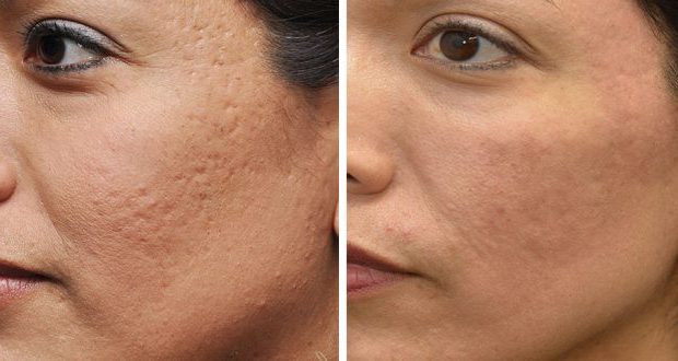 تخلصي من حفر الوجه بهذه الوصفات الطبيعية