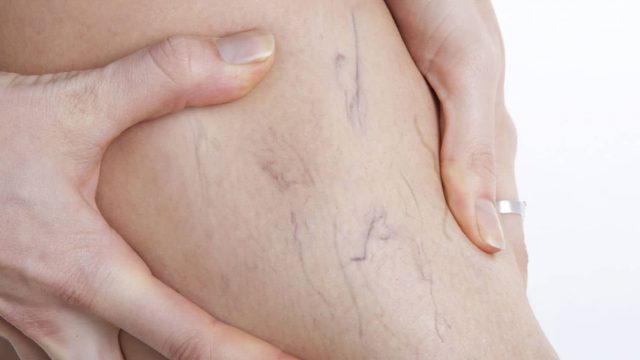 احمِ نفسك من دوالي الساقين مع هذه الوصفات