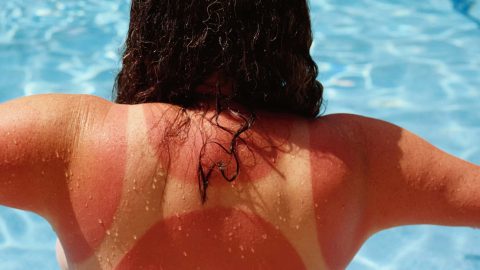 طرق طبيعية لعلاج حروق الشمس في المنزل