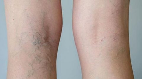 وصفة الألوة فيرا التفاح والخل للتخلص من الدوالي