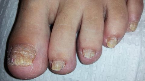 فطريات الأظافر.. أسبابها وطرق طبيعية لعلاجها