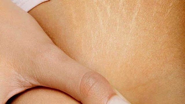 تخلصي من علامات التمدد في الجلد بهذه الوصفات المذهلة