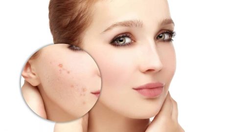 حب الشباب: أسبابه وطرق علاجه