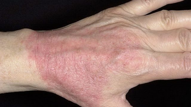 كيف تعالجين مرض الصدفية في المنزل؟