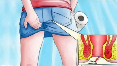 6 وصفات طبيعية وفعالة في علاج البواسير