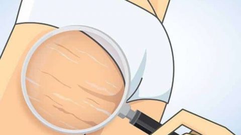 حاربي السيلوليت بتناول هذه الأطعمة