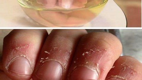 تقشر وجفاف الجلد حول الأظافر.. أسبابه وطرق علاجه