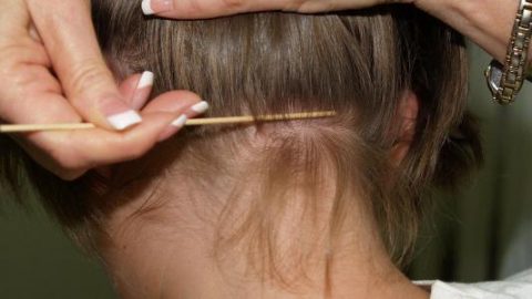 هكذا تتخلصين من مشكلة القمل عند طفلك بطرق طبيعية