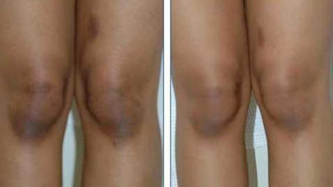 طرق طبيعية لتبييض الركبتين