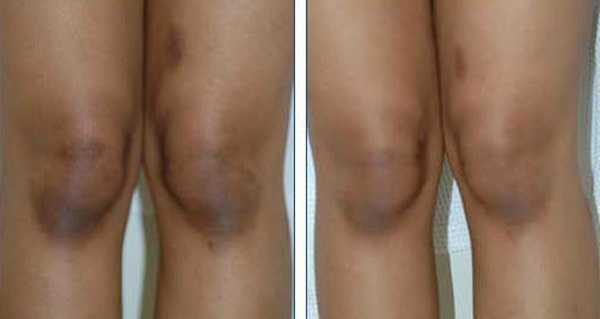 طرق طبيعية لتبييض الركبتين