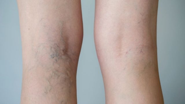 علاج زيت الزيتون وزهور الآذريون للتخلص من الدوالي