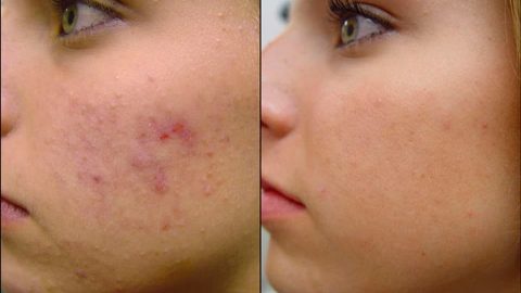 حبوب الوجه بعد المراهقة: الأسباب وطرق العلاج