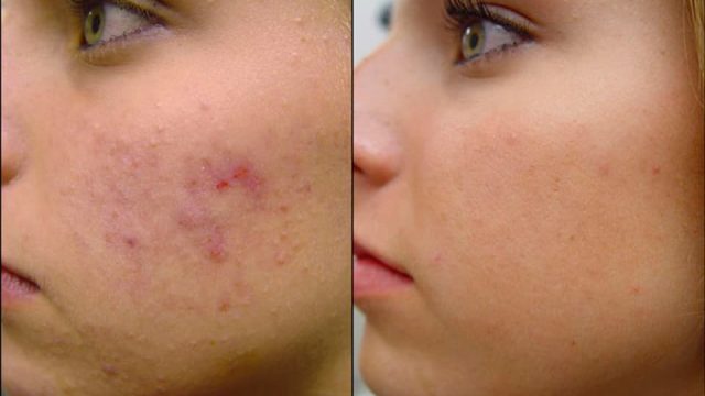 حبوب الوجه بعد المراهقة: الأسباب وطرق العلاج