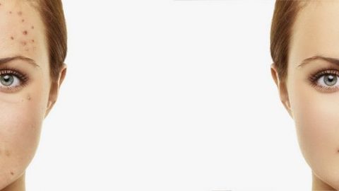 كريم طبيعي للتخفيف من الندوب