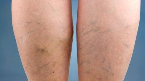 اتبعي عذه النصائح البسيطة للتخلص من الدوالي