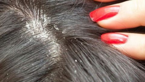 علاجات عشبية للتخلص من القمل والصئبان