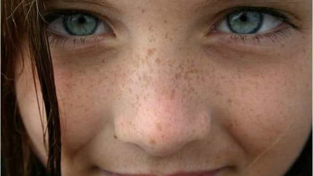 كيف تتخلصين من مشاكل النمش بشكل نهائي؟