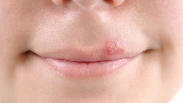 علاجات طبيعية للهربس الشفوي