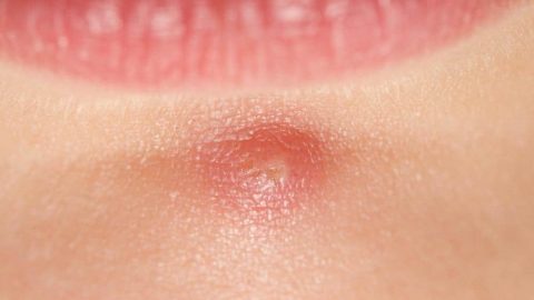 هذه المكونات تخلصك من الحبوب تحت الجلد