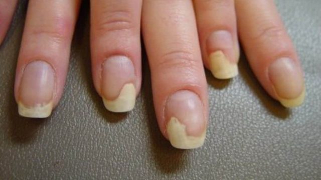 علاجات طبيعية للقضاء على فطريات الأظافر