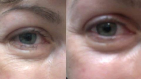 مكونات سهلة وفعالة للحد من انتفاخ العينين والهالات السوداء