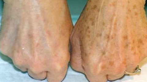 تخلصي من البقع التي تظهر على اليدين بهذه الطرق