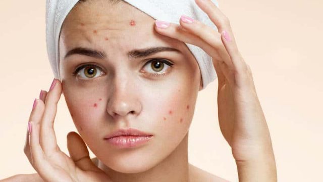 أعشاب طبيعية لعلاج حب الشباب.. اكتشفي ماهي