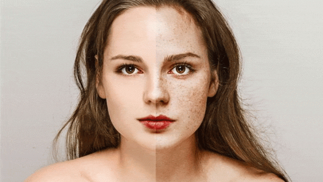 علاجات طبيعية للتخلص من النمش