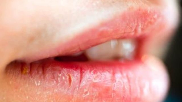 حلول طبيعية للتخلص من تشقق الشفاه