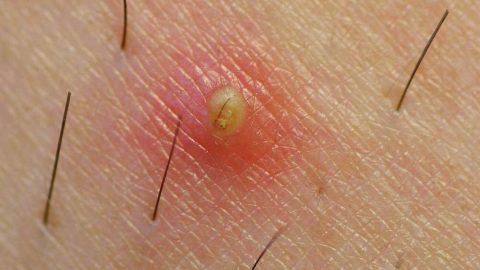 علاجات طبيعية للتخلص من الشعر النائم